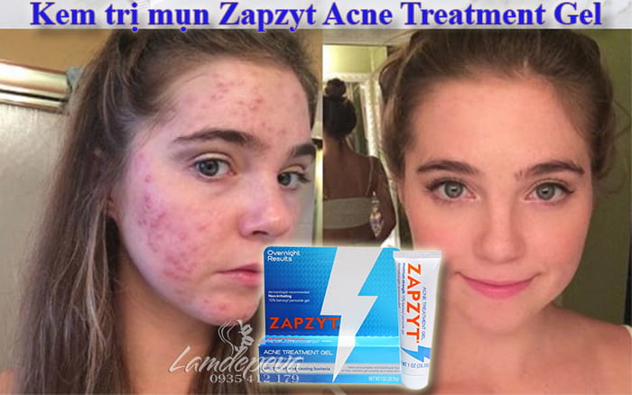 Kem trị mụn Zapzyt Acne Treatment Gel của Mỹ tuýp 28,35g2